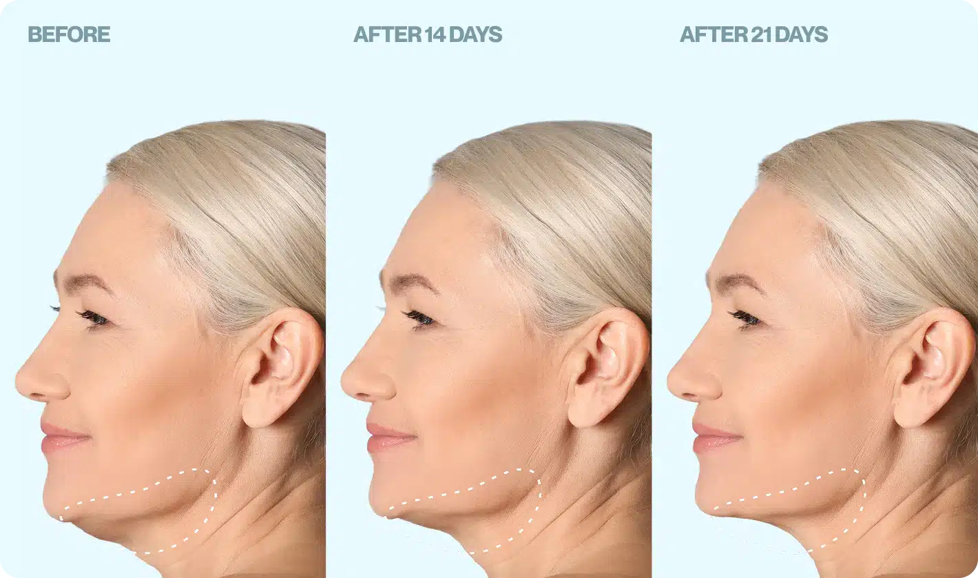 Renewalift Device (official Retailer) 2025