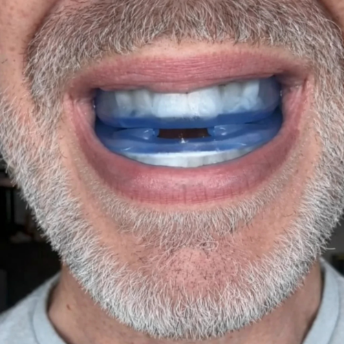 Trevalisse Anti-Snoring Mouthpiece - Official Retailer