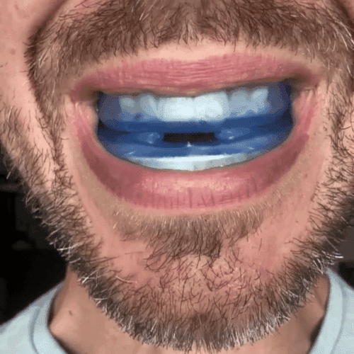 AirRest Anti-Snoring Mouthpiece (Official Retailer) [year]